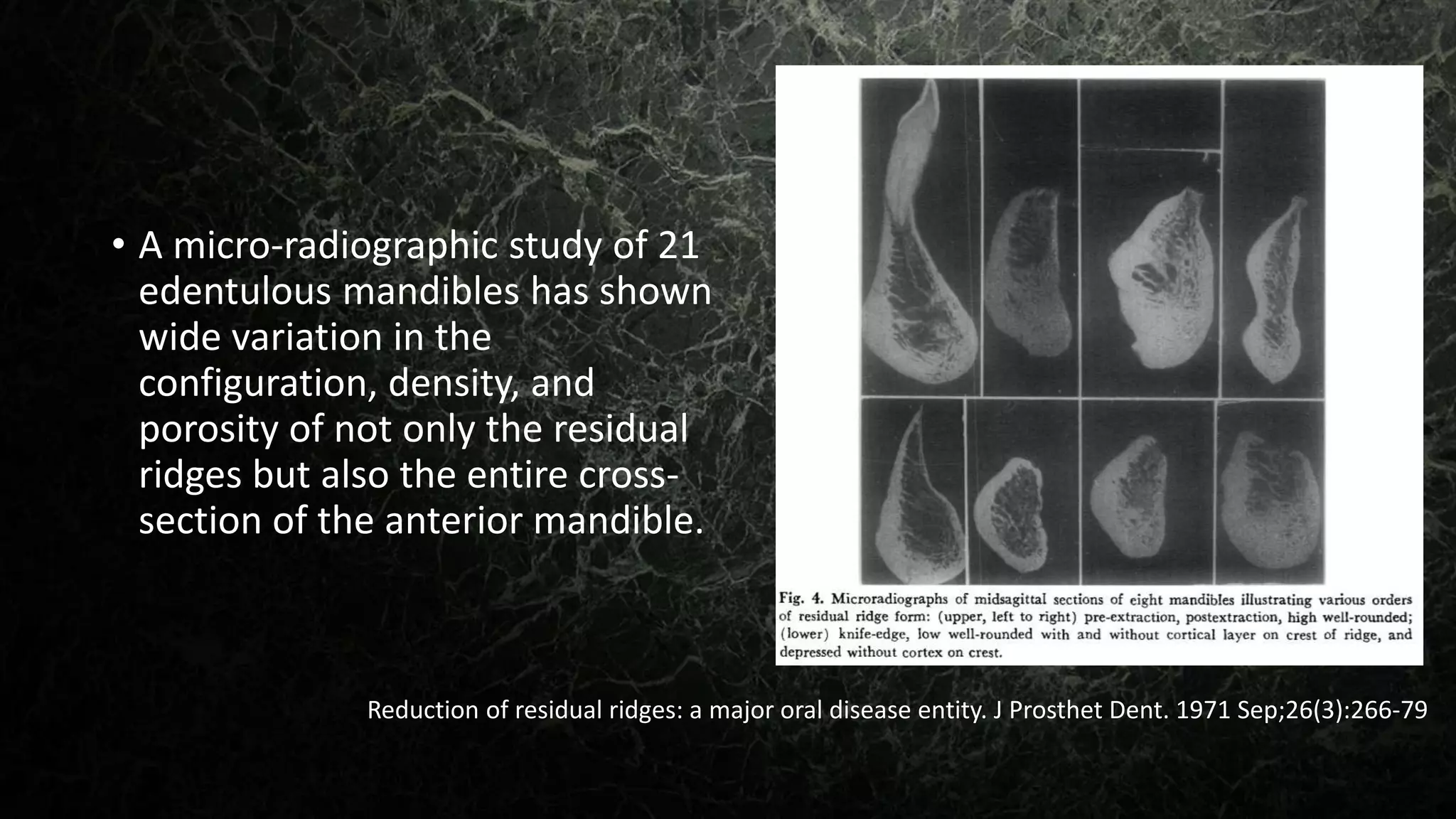 residual ridge resorption | PPTX