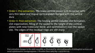 • Order I: Pre-extraction: The lower central incisor is in its socket with
very thin labial and lingual cortical plates merged with the lamina
dura
• Order II: Post-extraction: The healing period includes clot formation,
clot organization, filling of the socket to the height of the cortical
plates with new trabecular bone, and epithelization over the socket
site. The edges of the residual ridge are still sharp
Post-extraction changes in the adult mandible as illustrated by microradiographs of midsagittal sections and
serial cephalometric roentgenograms. J Prosthet Dent.1963 Sep 1;13(5):810-24.
 
