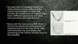• Dry specimens of mandible shows that
while external cortical surfaces of the
maxilla and mandible are uniformly
smooth, the crestal areas of residual ridges
have a different appearance and show
more porosities and imperfections.
• Bones with the most severe RRR (Orders V
and VI) may display the gross porosity of
medullary bone on the crest of the ridge
and eventually may even display the
uncovering of the inferior alveolar canal on
the mandible
 