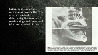 • Lateral cephalometric
radiographs provide the most
accurate method for
determining the amount of
residual ridge and the rate of
RRR over a period of time .
 