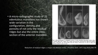 • A micro-radiographic study of 21
edentulous mandibles has shown
wide variation in the
configuration, density, and
porosity of not only the residual
ridges but also the entire cross-
section of the anterior mandible.
Reduction of residual ridges: a major oral disease entity. J Prosthet Dent. 1971 Sep;26(3):266-79
 
