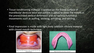 • Tissue conditioning material is applied on the tissue surface of
mandibular denture base and patient is asked to close the mouth in
the prerecorded vertical dimension and do various functional
movements such as puffing, blowing, whistling, and smiling.
• Final impression is made with light body addition silicone material
with closed mouth technique.
 