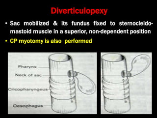 Stylalgia Hypopharyngeal pouch and stylalgia | PPT