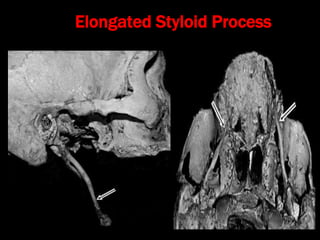 Stylalgia Hypopharyngeal pouch and stylalgia | PPT
