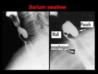 Stylalgia Hypopharyngeal pouch and stylalgia | PPT