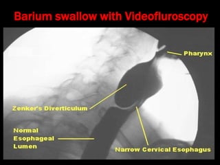 Stylalgia Hypopharyngeal pouch and stylalgia | PPT
