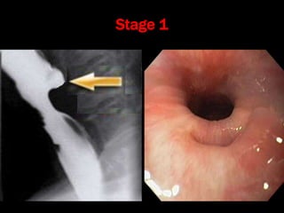 Stylalgia Hypopharyngeal pouch and stylalgia | PPT