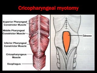 Stylalgia Hypopharyngeal pouch and stylalgia | PPT