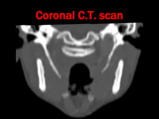 Stylalgia Hypopharyngeal pouch and stylalgia | PPT