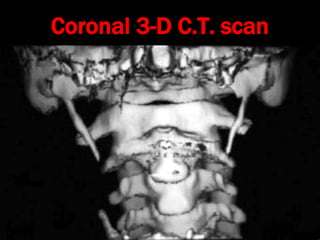 Stylalgia Hypopharyngeal pouch and stylalgia | PPT