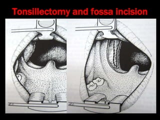 Stylalgia Hypopharyngeal pouch and stylalgia | PPT