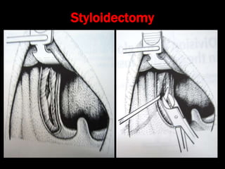 Stylalgia Hypopharyngeal pouch and stylalgia | PPT