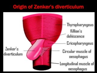 Stylalgia Hypopharyngeal pouch and stylalgia | PPT