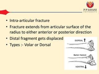 • Intra-articular fracture
• Fracture extends from articular surface of the
radius to either anterior or posterior direction
• Distal fragment gets displaced
• Types :- Volar or Dorsal
 