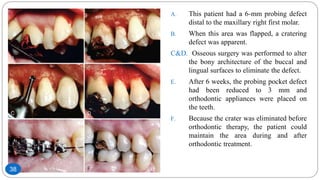 A. This patient had a 6-mm probing defect
distal to the maxillary right first molar.
B. When this area was flapped, a cratering
defect was apparent.
C&D. Osseous surgery was performed to alter
the bony architecture of the buccal and
lingual surfaces to eliminate the defect.
E. After 6 weeks, the probing pocket defect
had been reduced to 3 mm and
orthodontic appliances were placed on
the teeth.
F. Because the crater was eliminated before
orthodontic therapy, the patient could
maintain the area during and after
orthodontic treatment.
38
 