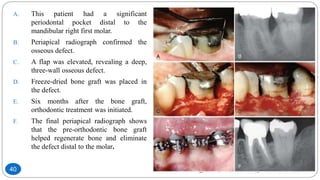A. This patient had a significant
periodontal pocket distal to the
mandibular right first molar.
B. Periapical radiograph confirmed the
osseous defect.
C. A flap was elevated, revealing a deep,
three-wall osseous defect.
D. Freeze-dried bone graft was placed in
the defect.
E. Six months after the bone graft,
orthodontic treatment was initiated.
F. The final periapical radiograph shows
that the pre-orthodontic bone graft
helped regenerate bone and eliminate
the defect distal to the molar.
40
 