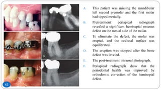 A. This patient was missing the mandibular
left second premolar and the first molar
had tipped mesially.
B. Pretreatment periapical radiograph
revealed a significant hemiseptal osseous
defect on the mesial side of the molar.
C. To eliminate the defect, the molar was
erupted, and the occlusal surface was
equilibrated.
D. The eruption was stopped after the bone
defect was leveled.
E. The post-treatment intraoral photograph.
F. Periapical radiograph show that the
periodontal health was improved by
orthodontic correction of the hemiseptal
defect.
43
 
