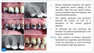 A. Before orthodontic treatment, this patient
had significant mesial tipping of the
maxillary right first and second molars,
causing marginal ridge discrepancies and
deep periodontal pockets.
B. The tipping produced root proximity
between the molars as well as a
disruption of the normal gingival
anatomy.
C. To eliminate the root proximity, the
brackets were placed perpendicular to the
long axes of the teeth.
D,E&F. This method of bracket placement
facilitated root alignment and elimination
of the root proximity, as well as leveling
of the marginal ridge discrepancies.
46
 