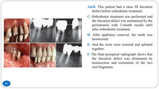 A&B. This patient had a class III furcation
defect before orthodontic treatment.
C. Orthodontic treatment was performed and
the furcation defect was maintained by the
periodontist with 2-month recalls until
after orthodontic treatment.
D. After appliance removal, the tooth was
hemisected.
E. And the roots were restored and splinted
together.
F. The final periapical radiograph shows that
the furcation defect was eliminated by
hemisection and restoration of the two
root fragments.
51
 
