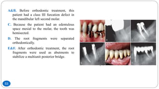 A&B. Before orthodontic treatment, this
patient had a class III furcation defect in
the mandibular left second molar.
C. Because the patient had an edentulous
space mesial to the molar, the tooth was
hemisected.
D. The root fragments were separated
orthodontically.
E&F. After orthodontic treatment, the root
fragments were used as abutments to
stabilize a multiunit posterior bridge.
53
 