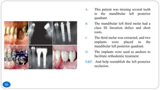 A. This patient was missing several teeth
in the mandibular left posterior
quadrant.
B. The mandibular left third molar had a
class III furcation defect and short
roots.
C. The third molar was extracted, and two
implants were placed in the
mandibular left posterior quadrant.
D. The implants were used as anchors to
facilitate orthodontic treatment.
E&F. And help reestablish the left posterior
occlusion.
55
 