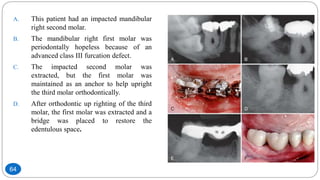 A. This patient had an impacted mandibular
right second molar.
B. The mandibular right first molar was
periodontally hopeless because of an
advanced class III furcation defect.
C. The impacted second molar was
extracted, but the first molar was
maintained as an anchor to help upright
the third molar orthodontically.
D. After orthodontic up righting of the third
molar, the first molar was extracted and a
bridge was placed to restore the
edentulous space.
64
 