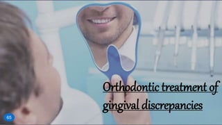 Orthodontic treatment of
gingival discrepancies
65
 