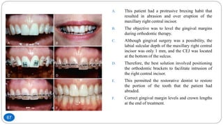 A. This patient had a protrusive bruxing habit that
resulted in abrasion and over eruption of the
maxillary right central incisor.
B. The objective was to level the gingival margins
during orthodontic therapy.
C. Although gingival surgery was a possibility, the
labial sulcular depth of the maxillary right central
incisor was only 1 mm, and the CEJ was located
at the bottom of the sulcus.
D. Therefore, the best solution involved positioning
the orthodontic brackets to facilitate intrusion of
the right central incisor.
E. This permitted the restorative dentist to restore
the portion of the tooth that the patient had
abraded.
F. Correct gingival margin levels and crown lengths
at the end of treatment.
67
 