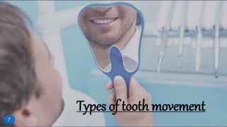Types of tooth movement
7
 