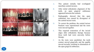 A. This patient initially had overlapped
maxillary central incisors.
B. After initial orthodontic alignment of the
teeth, an open gingival embrasure
appeared between the centrals.
C. Radiography showed that the open
embrasure was caused by divergence of
the central incisor roots.
D. To correct the problem, the central incisor
brackets were repositioned and the roots
were moved together.
E. This required restoration of the incisal
edges after orthodontic therapy because
these teeth had worn unevenly before
therapy.
F. As the roots were paralleled, the tooth
contact moved gingivally and the papilla
moved incisally, resulting in elimination of
the open gingival embrasure.
72
 