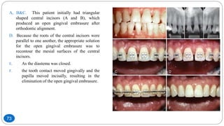 A, B&C. This patient initially had triangular
shaped central incisors (A and B), which
produced an open gingival embrasure after
orthodontic alignment.
D. Because the roots of the central incisors were
parallel to one another, the appropriate solution
for the open gingival embrasure was to
recontour the mesial surfaces of the central
incisors.
E. As the diastema was closed.
F. the tooth contact moved gingivally and the
papilla moved incisally, resulting in the
elimination of the open gingival embrasure.
73
 