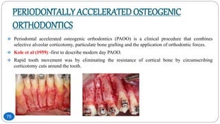 PERIODONTALLY ACCELERATED OSTEOGENIC
ORTHODONTICS
 Periodontal accelerated osteogenic orthodontics (PAOO) is a clinical procedure that combines
selective alveolar corticotomy, particulate bone grafting and the application of orthodontic forces.
 Kole et al (1959) -first to describe modern day PAOO.
 Rapid tooth movement was by eliminating the resistance of cortical bone by circumscribing
corticotomy cuts around the tooth.
75
 