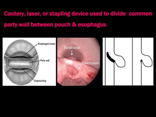 Stylalgia 9. hypopharyngeal pouch and stylalgia | PPT