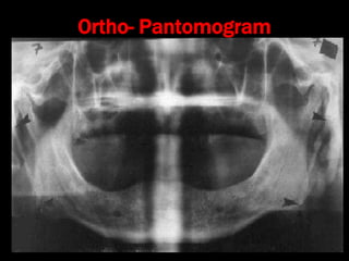 Stylalgia 9. hypopharyngeal pouch and stylalgia | PPT