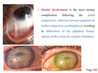 Page 130
• Ocular involvement is the most serious
complication following the initial
conjuctivitis, adhesion between palpebral &
bulbar conjuctivae (symblepharon) resulting
in obliteration of the palpebral fissure,
opacity of the cornea & complete blindness.
 