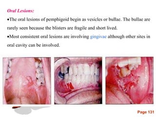 Page 131
Oral Lesions:
The oral lesions of pemphigoid begin as vesicles or bullae. The bullae are
rarely seen because the blisters are fragile and short lived.
Most consistent oral lesions are involving gingivae although other sites in
oral cavity can be involved.
 