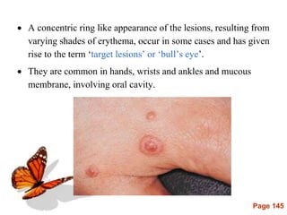 Page 145
 A concentric ring like appearance of the lesions, resulting from
varying shades of erythema, occur in some cases and has given
rise to the term ‘target lesions’ or ‘bull’s eye’.
 They are common in hands, wrists and ankles and mucous
membrane, involving oral cavity.
 