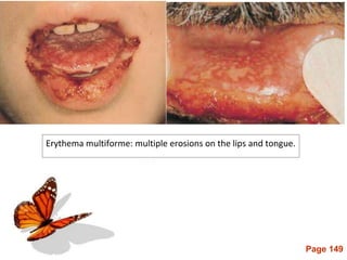 Page 149
Erythema multiforme: multiple erosions on the lips and tongue.
 