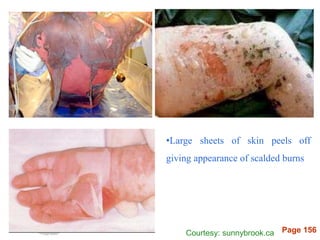 Page 156
•Large sheets of skin peels off
giving appearance of scalded burns
Courtesy: sunnybrook.ca
 