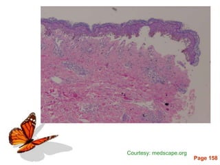 Page 158
Courtesy: medscape.org
 