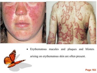 Page 163
 Erythematous macules and plaques and blisters
arising on erythematous skin are often present.
 