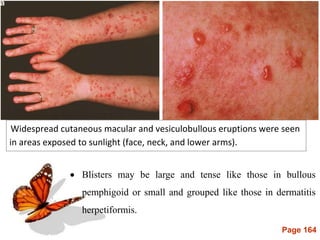 Page 164
 Blisters may be large and tense like those in bullous
pemphigoid or small and grouped like those in dermatitis
herpetiformis.
Widespread cutaneous macular and vesiculobullous eruptions were seen
in areas exposed to sunlight (face, neck, and lower arms).
 