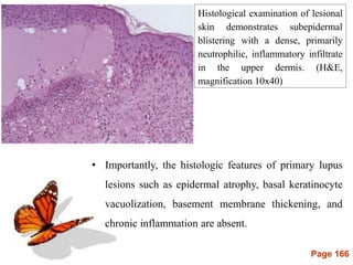 Page 166
Histological examination of lesional
skin demonstrates subepidermal
blistering with a dense, primarily
neutrophilic, inflammatory infiltrate
in the upper dermis. (H&E,
magnification 10x40)
• Importantly, the histologic features of primary lupus
lesions such as epidermal atrophy, basal keratinocyte
vacuolization, basement membrane thickening, and
chronic inflammation are absent.
 