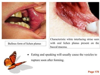 Page 179
 Eating and speaking will usually cause the vesicles to
rupture soon after forming.
Bullous form of lichen planus
Characteristic white interlacing striae seen
with oral lichen planus present on the
buccal mucosa.
 