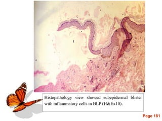 Page 181
Histopathology view showed subepidermal blister
with inflammatory cells in BLP (H&Ex10).
 