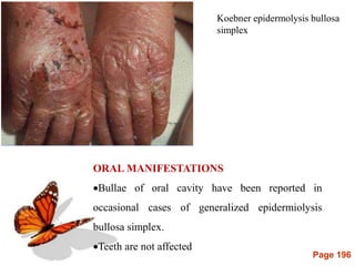 Page 196
Koebner epidermolysis bullosa
simplex
ORAL MANIFESTATIONS
Bullae of oral cavity have been reported in
occasional cases of generalized epidermiolysis
bullosa simplex.
Teeth are not affected
 