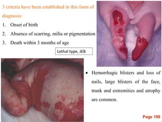 Page 199
3 criteria have been established in this form of
diagnosis:
1. Onset of birth
2. Absence of scarring, milia or pigmentation
3. Death within 3 months of age
Lethal type, JEB
 Hemorrhagic blisters and loss of
nails, large blisters of the face,
trunk and extremities and atrophy
are common.
 