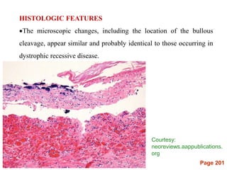 Page 201
HISTOLOGIC FEATURES
The microscopic changes, including the location of the bullous
cleavage, appear similar and probably identical to those occurring in
dystrophic recessive disease.
Courtesy:
neoreviews.aappublications.
org
 