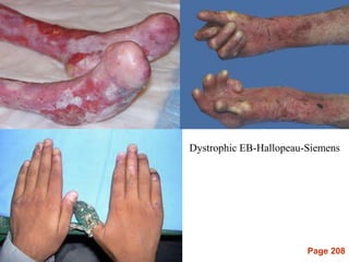 Page 208
Dystrophic EB-Hallopeau-Siemens
 