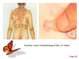 Page 35
Courtesy: Lever’s Histopathology of Skin, 2nd edition
 